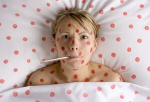 Woman covered in red spots lying in bed with thermometer in mouth, statutory sick pay concept